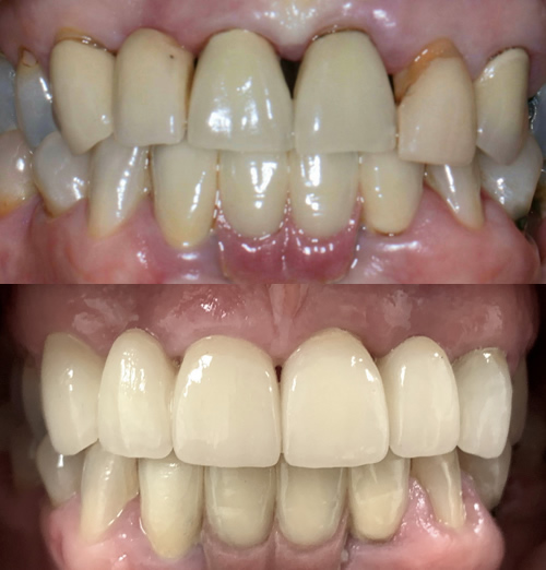 Judith dental veneers in Huddersfield